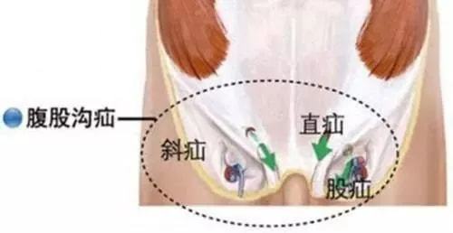 疝气最新疗法探索，创新治疗手段揭秘